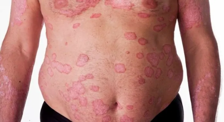 La obesidad puede empeorar la psoriasis