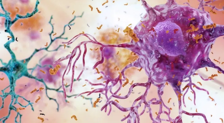 Neurólogos buscan dar con una terapia exitosa para atacar el Alzheimer