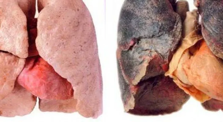 Síntomas de cáncer de pulmón que no debes ignorar 