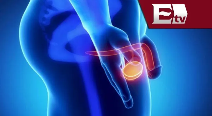 Cáncer de próstata: Síntomas y Factores de riesgo
