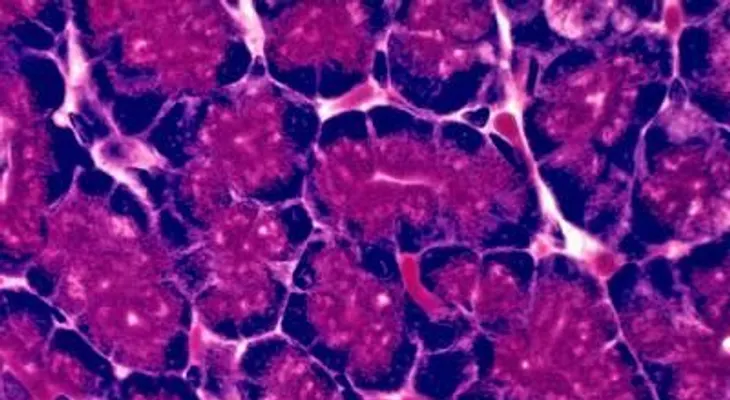 Un nuevo test para detectar precozmente cáncer de páncreas