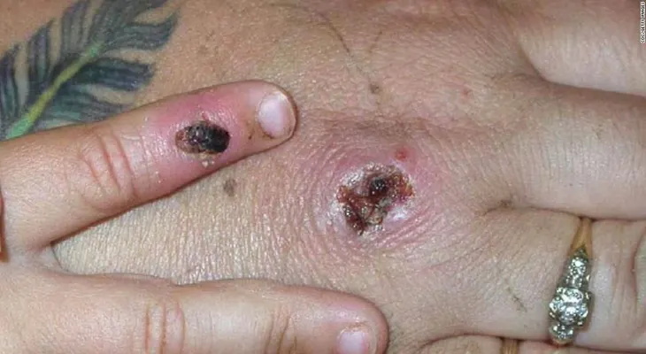 Registran primeros casos de una extraña infección llamada viruela del simio en Reino Unido