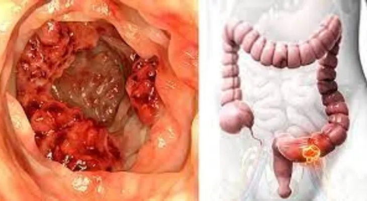 Este aceite destruye el 90% células del cáncer de colon en 3 dí­as, según demostración científica
