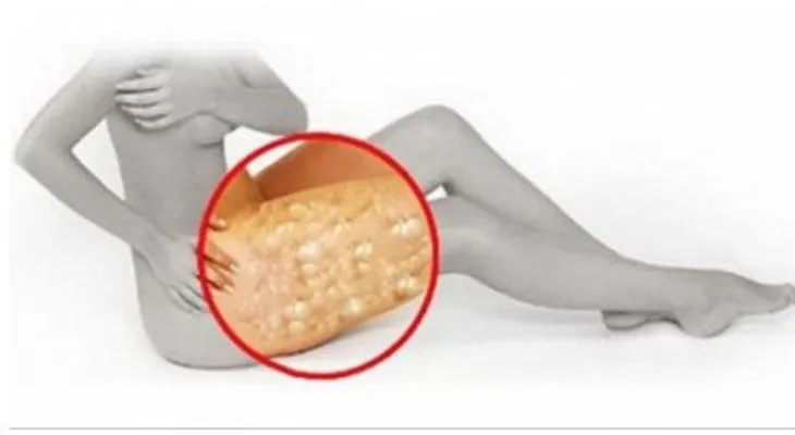Mira como el vinagre ayuda a desaparecer la celulitis magicamente