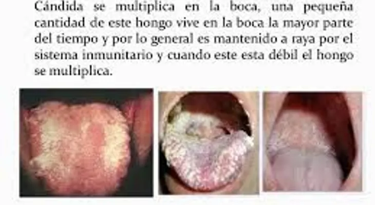 La candidiasis; causas y prevención (VIDEO)