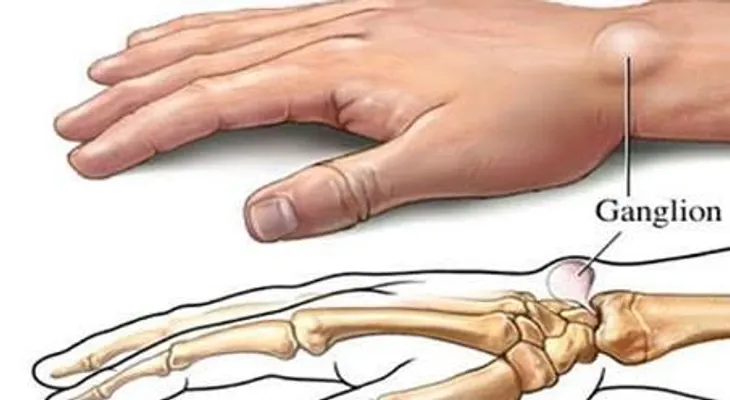 Si tienes bultos en la muñeca, descubre las 5 causas más frecuentes y cómo solucionarlo!