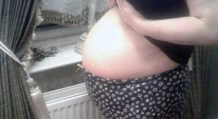 Una mujer tuvo 3 años su abdomen inflamado; parecía un embarazo