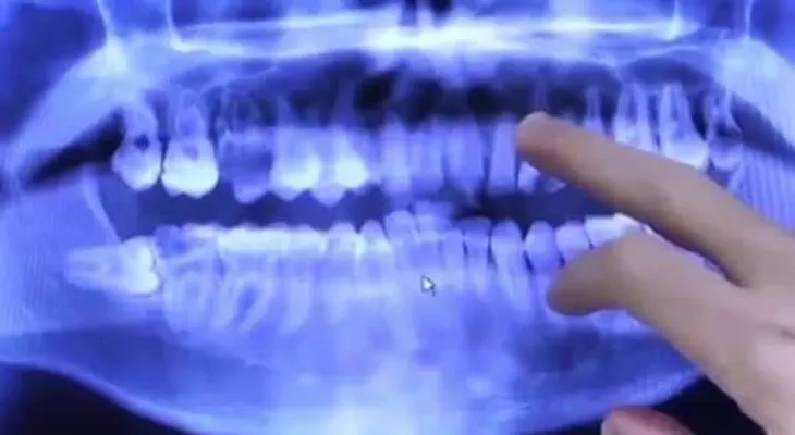 Muestra sus dientes luego de 20 años sin lavárselos
