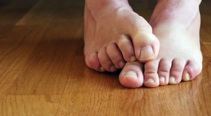 6 Remedios para tratar naturalmente el pie de atleta
