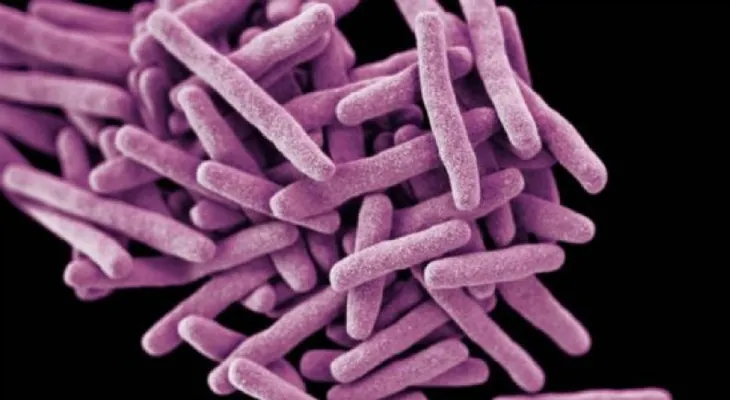 Preocupación en EE.UU. por paciente con tuberculosis resistente a medicamentos