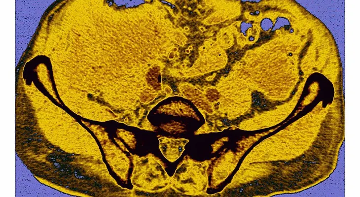 Amiloidosis, una enfermedad rara que deteriora los órganos vitales
