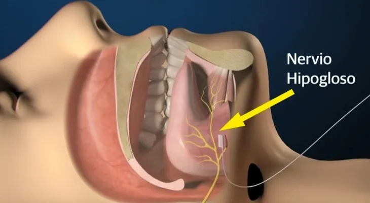 ¿Roncas mucho? Quizá sufres apnea del sueño