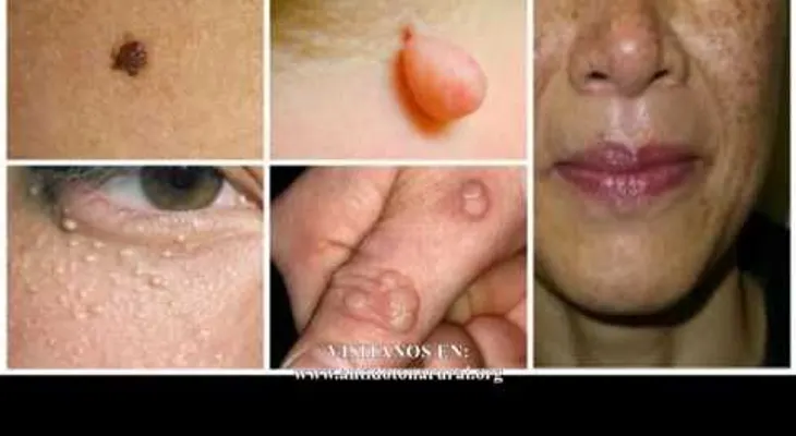 Desaparece tus verrugas, lunares, espinillas y manchas de edad para siempre de manera natural (VIDEO) 