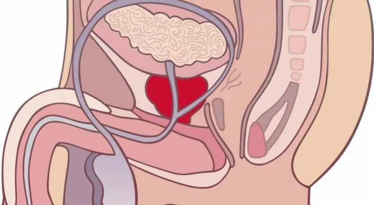 Los sintomas de una prostata enferma