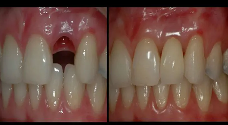 Dile adiós a los implantes dentales. Cómo hacer crecer un diente en 2 meses