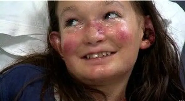 La niña cuya piel nunca se cura