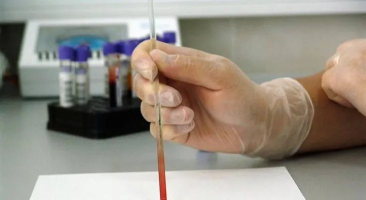  Un nuevo análisis de sangre ayuda a predecir el riesgo de cáncer de pulmón 