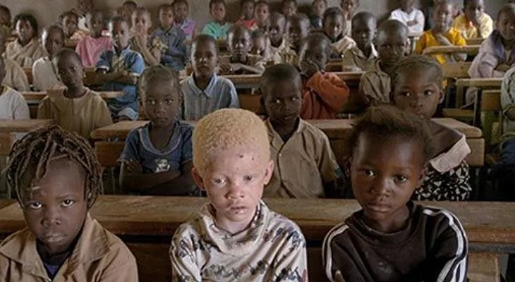 La caza de los niños albinos en África, víctimas de la magia y la superstición