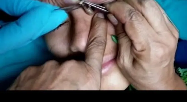 Conozca estos parásitos en el ano, y otros casos asquerosos 
