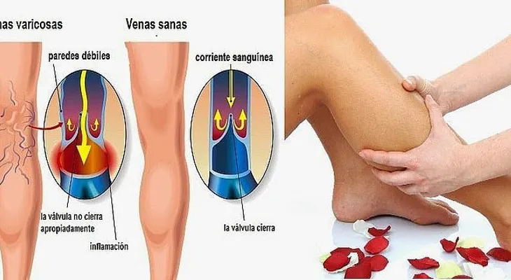 MI amigo dermatólogo me enseñó este remedio para las arañitas o várices