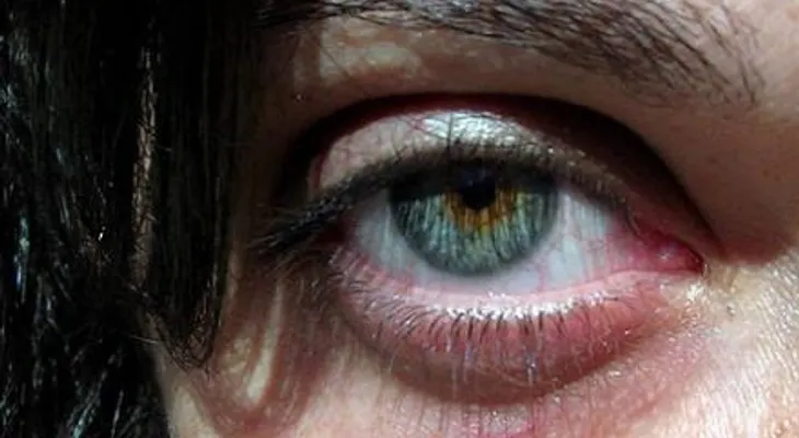 Ojeras: sus causas y cómo prevenirlas
