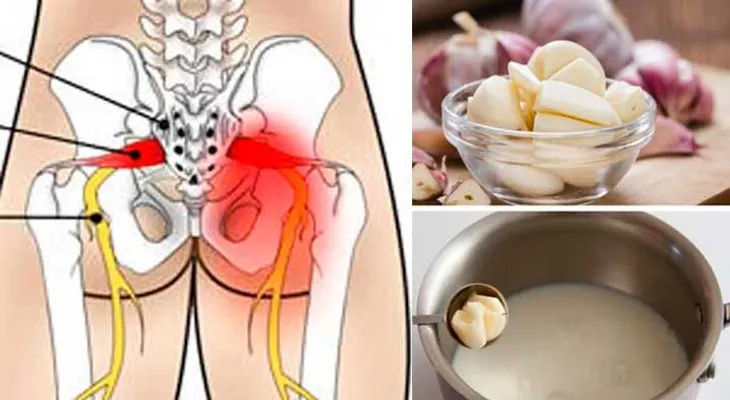 Si sufres de ciática, este remedio es buenísimo 