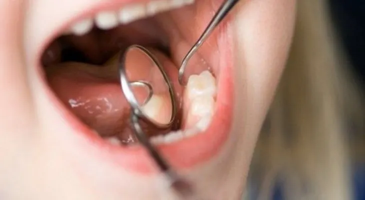 9 mitos y verdades sobre las caries