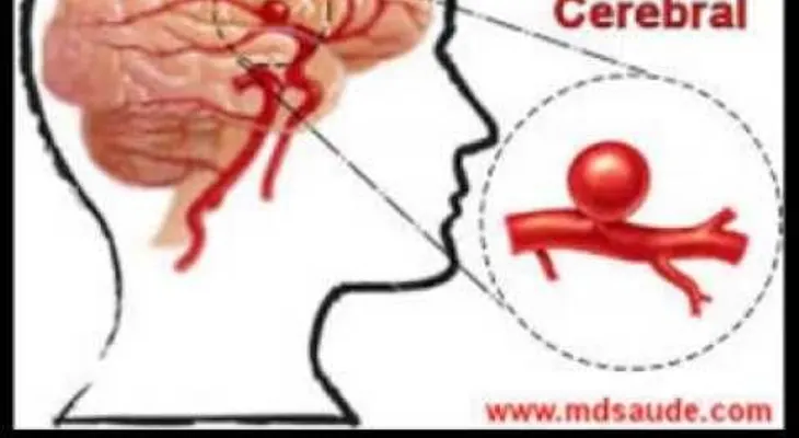 Aneurisma Cerebral 
