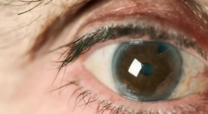 Niños malnutridos son susceptibles a padecer cataratas y glaucomas