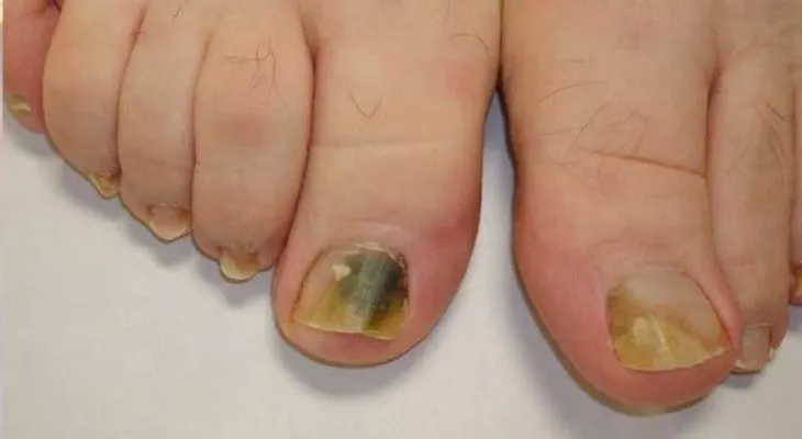 Este es el Mejor Remedio Para Eliminar Los Hongos De Las Uñas