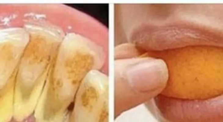 La receta para eliminar el sarro y blanquear tus dientes que un dentista nunca te dirás