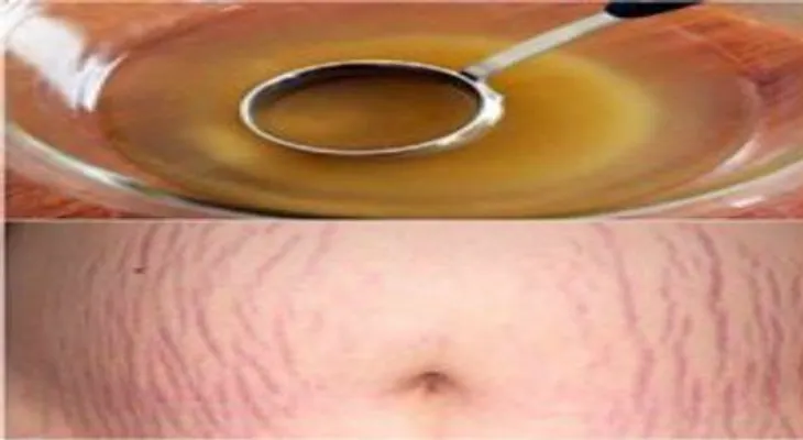 Un ingrediente mágico para las estrías después del parto!