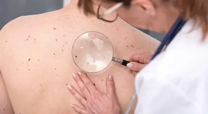 Descubren cómo funciona la primera línea de defensa contra el cáncer de piel