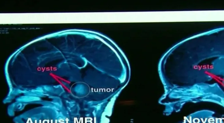 ¿Un beso del papá está ayudando a curar el cáncer de una bebé?