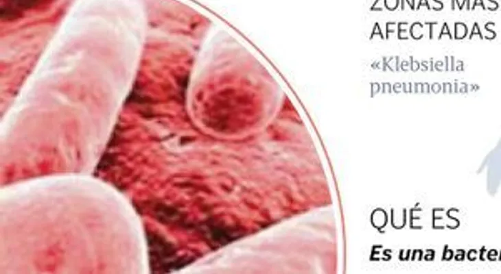 Enfermedad de la "Klebsiella" se puede pegar por contacto en hospitales