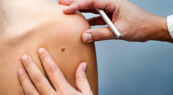Diseñan un sistema para detectar al "patito feo" que puede acabar en melanoma