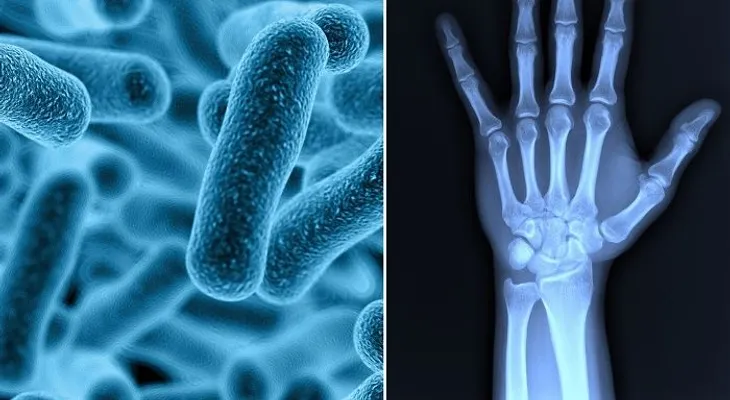 Dolor de articulaciones está relacionado con bacterias en el intestino