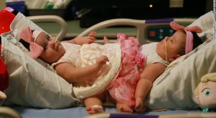 Separan a hermanas siamesas en compleja operación de más de 12 horas