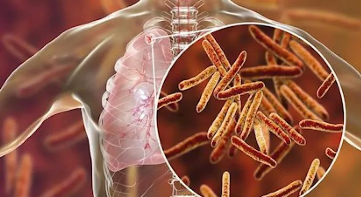 Tuberculosis: un nuevo método acorta el tiempo de diagnóstico y epidemiología