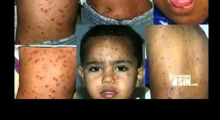 Conozca el virus que en la adultez puede ser fatal (VIDEO)