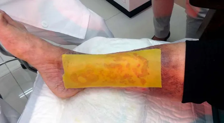 Científicos crean un parche y logran cicatrizar pie diabético con miel de abeja