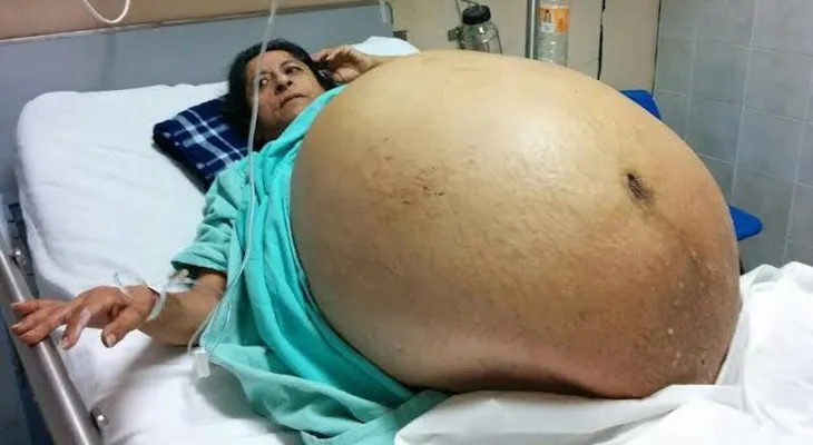 El antes y después de la mujer con tumor más grande del mundo
