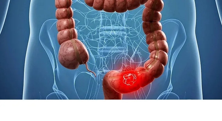 El cáncer colorrectal, una enfermedad que puede confundirse con colitis