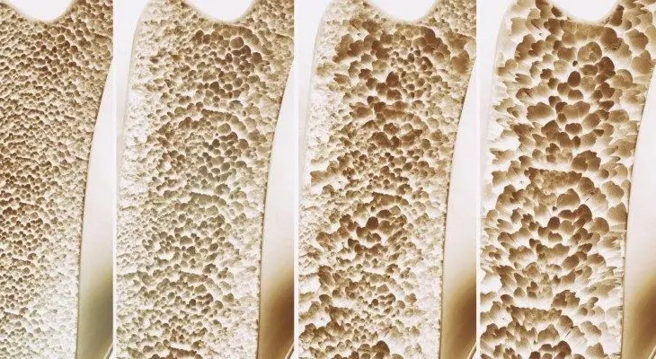 Crean medicamento que restaura huesos para combatir la osteoporosis