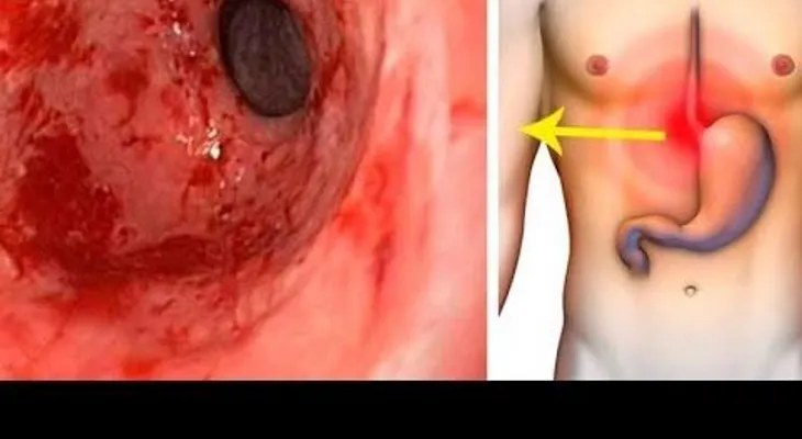 Un remedio que no falla para eliminar la gastritis y la acidez estomacal para siempre