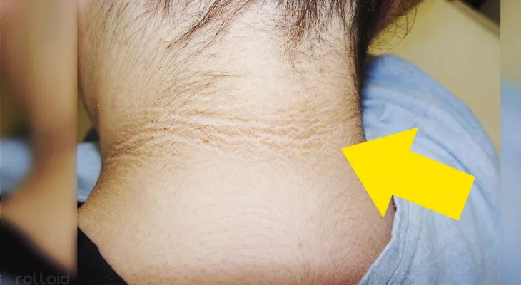 Su madre vio esa mancha oscura alrededor del cuello, pero NUNCA imaginó que los médicos dijeran esto?