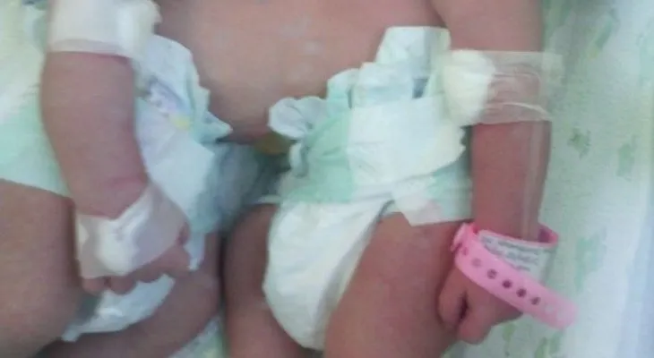 Nacen siamesas unidas por el abdomen en el hospital Cabral y Báez 