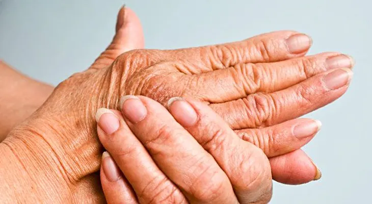 5 alimentos que no debes comer si tienes artritis psoriásica