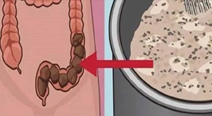Imperdible, conoce el efectivo remedio que elimina toda la mugre y la caca acumulada del colon...! 