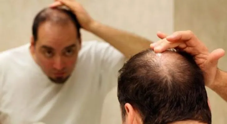 Este hombre tuvo resultados increíbles mezclando plátanos, cerveza, huevo y miel para evitar caída del cabello